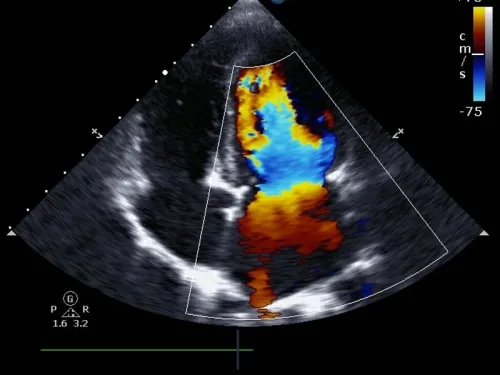 Fração de Ejeção: O Número do Ecocardiograma Explicado