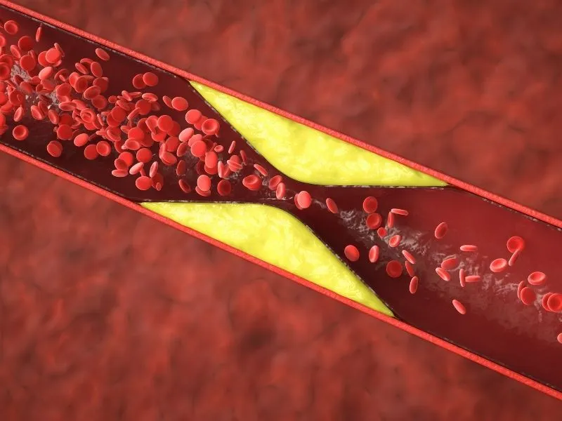Doença Arterial Coronariana: Causas, Sintomas e Tratamentos