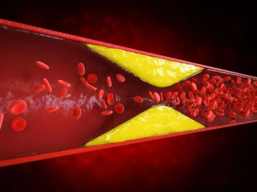 Aterosclerose: Como as Placas se Formam Antes do Infarto