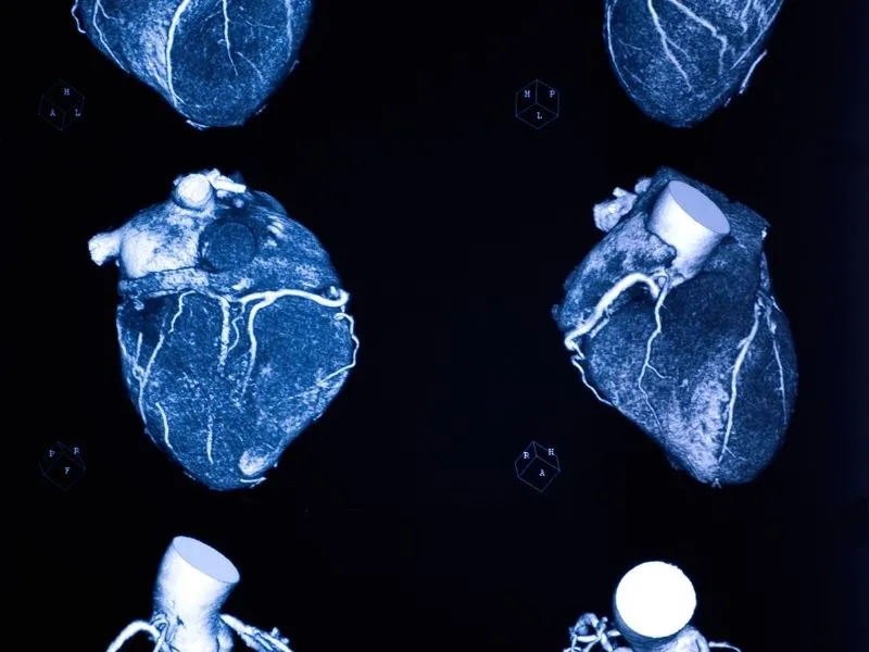 Tomografia de Coronárias: Quando Pedir e o Que Detecta?