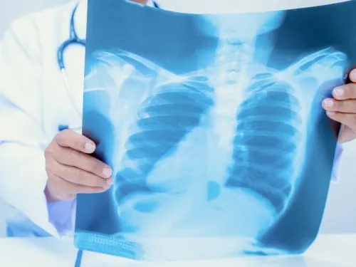 Hipertensão Pulmonar: sintomas, diagnóstico e tratamento