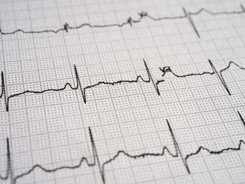Fibrilação Atrial: O Que É, Sintomas, Riscos e Tratamento 