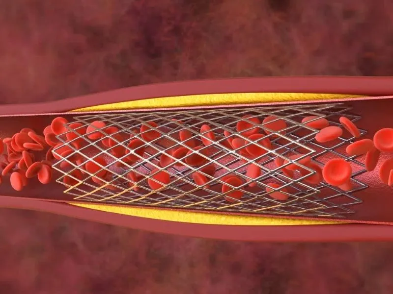 Stent no Coração: O Que É, Como É Colocado e os Cuidados