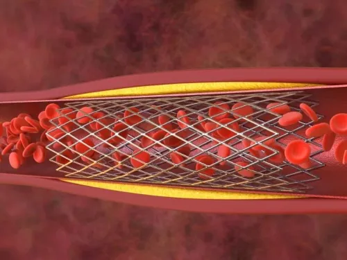 Stent no Coração: O Que É, Como É Colocado e os Cuidados