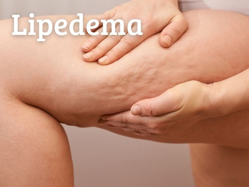 Por que dieta e exercícios não funcionam no lipedema (e o que realmente ajuda)