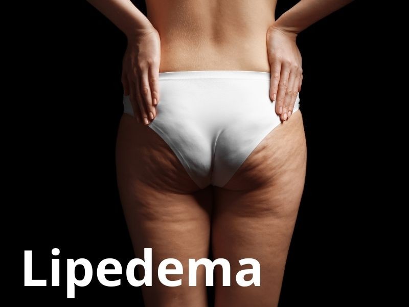 O que é lipedema? Como diferenciar de obesidade e lipedema