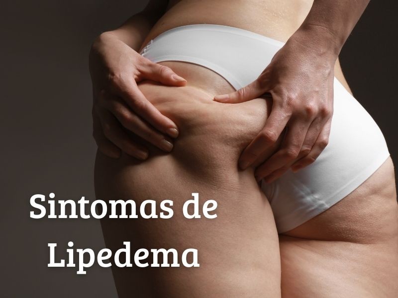 Os principais sinais de lipedema que muitas pessoas ignoram (hematomas, dor, inchaço)